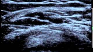 Shoulder Bursitis Ultrasound Guided Injection [upl. by Earleen554]