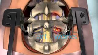 3D Medical Animation  Lumbar spine surgical procedure 2 level fusion of L4S1 [upl. by Marieann]