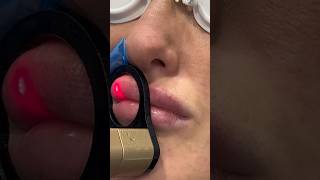 Wrinkle Free Lips with CO2 Resurfacing Laser  Dr Medispa [upl. by Eisseb]