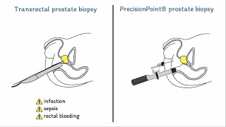 Prostate Biopsies Explained Transrectal vs PrecisionPoint® [upl. by Eserehs563]