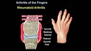 Arthritis Of The Fingers causes symptoms diagnosis and treatment [upl. by Nerahs784]