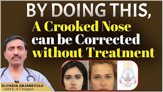 How to Treat Deviated Nasal Septum at Home  Correction of a Crooked Nose   Socialpost Healthcare [upl. by Leuqer]