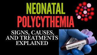 Neonatal Polycythemia Signs Causes and Treatments Explained [upl. by Azalea]