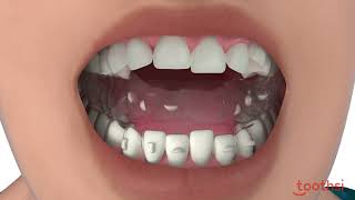 Toothsi Aligner Teeth Alignment Teeth Straightening  Teeth Gap Treatment [upl. by Halie]