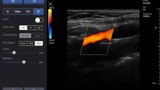 SONON 300L Wireless Handheld Ultrasound  Color Doppler video Carotid [upl. by Amri528]