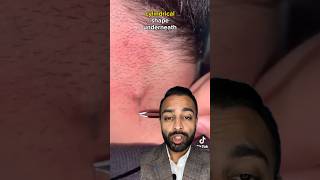 Ingrown Hair Extraction  Dr Somji Reacts [upl. by Naara]