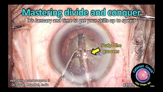 CataractCoach™ 2089 mastering divide and conquer phaco technique [upl. by Ahsienad]