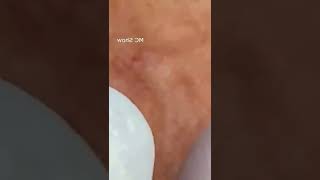 Pickel Ausdrücken Blackheads Akne amp Mitesser entfernen 🔴 4 [upl. by Hanforrd445]