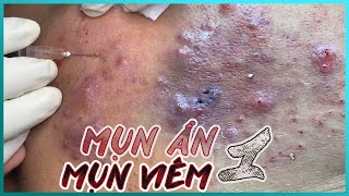 Big Cystic Acne Blackheads Extraction Blackheads amp Milia Whiteheads Removal Pimple Popping [upl. by Kendricks]