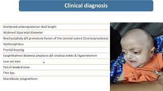 Crouzon’s Syndrome  Spot Diagnosis  4  Pediatrics [upl. by Lacagnia]