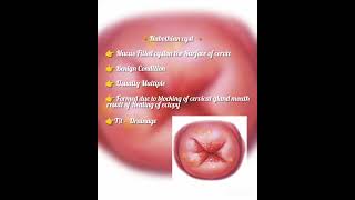 Nabothian cyst gynaecologists trending trendingshorts viralvideo viralshorts reels gynae [upl. by Duaner568]