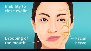 Symptoms Features and Presentations of Bells palsy [upl. by Zalucki]