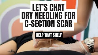 Dry Needling For CSection Scar [upl. by Knarf]