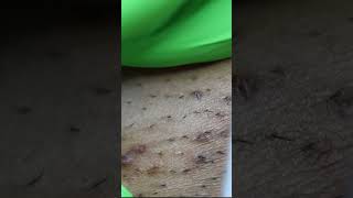 SHOCKING EXTRACTION OF BLACKHEAD AND HAIR INGROWN REMOVAL VIDEOS PART 2 [upl. by Parnas]