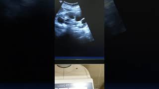 Ultrasound video showing multicystic dysplastic kidney in a hypertensive patient [upl. by Einnad]