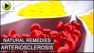 Arteriosclerosis  Natural Ayurvedic Home Remedies [upl. by Acherman]