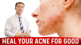 What Causes Pimples and How to Get Rid of Acne [upl. by Tobe]