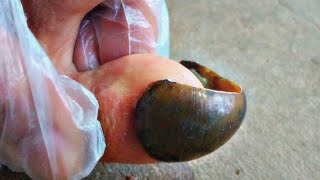 Extreme Toenail Transformation Cutting Long Curved Smelly Toenails [upl. by Zzaj]