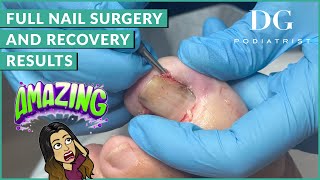 Full Nail Surgery and Recovery Results  The Foot Scraper DG Podiatrist [upl. by Bocock]