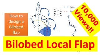 How to design a bilobed local flap [upl. by Aiset]