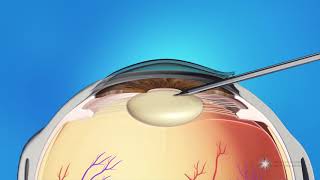 Phacoemulsification Cataract Surgery [upl. by Nilya]