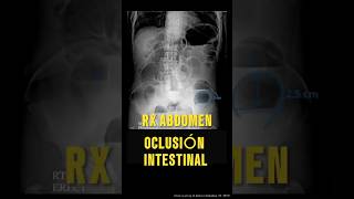 APRENDE A DIAGNOSTICAR OCLUSIÓN INTESTINAL CON RADIOGRAFÍA Oclusion RadiologíaDiagnóstico [upl. by Razaele]