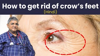 how to get rid of crows feet  crows feet  how to get rid of crows feet and bags under your eyes [upl. by Sutphin]