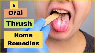 How To Treat Oral Thrush Oral Candidiasis Or Yeast Infection At Home  Best Home Remedies [upl. by Alessandra735]