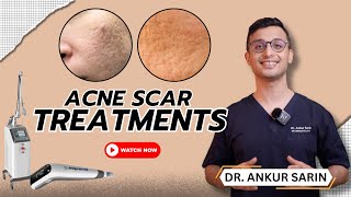 How I Treat Acne Scars  Dermatologist  Best devices Morpheus Dermapen 4  l Dr Sarin [upl. by Llerud]