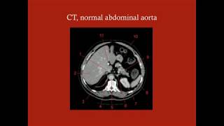 Abdominal Aortic Aneurysm  CRASH Medical Review Series [upl. by Esadnac]