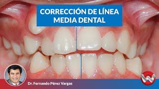 Corrección de linea media dental [upl. by Chi]