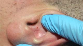 Ángels Acne Treatment Blackheads on the Ear [upl. by Stover]