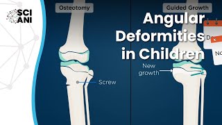 Bow legs and knock knees in children when and how to correct them [upl. by Nagad]