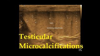 Testicular Microcalcifications  Ultrasound  Case [upl. by Hoban361]