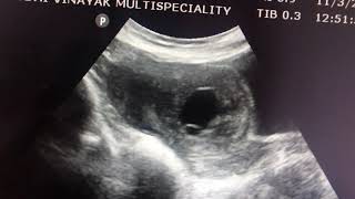 Scar ectopic ultrasound sonography [upl. by Rasec]