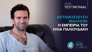 Μεταμόσχευση Μαλλιών FUE  Αποτελέσματα Πριν και Μετά  Η Εμπειρία του Ηλία Παλιουδάκη [upl. by Alrzc530]