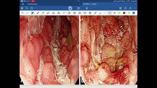 Inflammatory bowel disease [upl. by Patman]