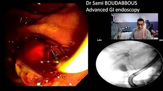 ERCP for acute cholangitis  hydatic cyst [upl. by Aihsia274]