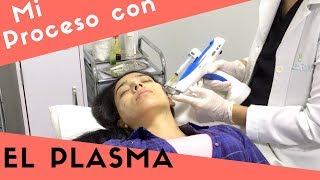 ME HICE EL PLASMA EN MI ROSTRO  Paso a paso  Plasma rico en plaquetas [upl. by Roos200]