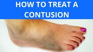 How To Treat a Contusion [upl. by Eenal]