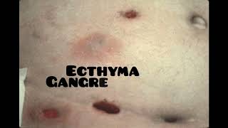 ecthyma causes symptoms and treatment dermatologyskin disease [upl. by Shanta966]