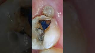 steps procedure on a 2nd molar cavity desensitizing a large cavity with pulp exposure [upl. by Adlitam]