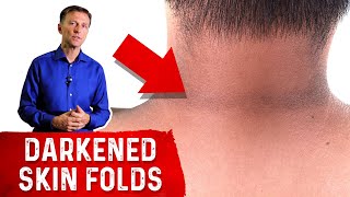 How to Reverse Acanthosis Nigricans [upl. by Sumner]