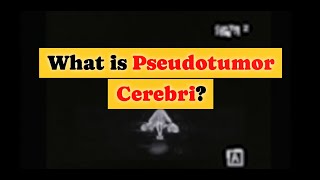 What is Pseudotumor Cerebri [upl. by Rome]