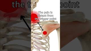 Infraspinatus Trigger Points [upl. by Nayllij566]