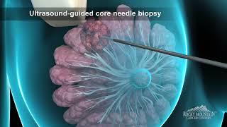 Breast Biopsy Animation [upl. by Matronna700]