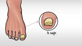 Fungal nail infection [upl. by Herrah]