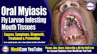 Oral Myiasis Infesting Mouth Tissues  Causes Symptoms Diagnosis and Treatment  Medicam YouTube [upl. by Frazier415]