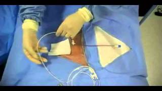 Insertion of Transvenous Pacemaker [upl. by Lisan]