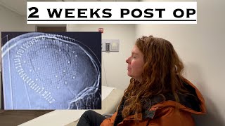 My experience so far 2 weeks after craniotomy surgery for removal of a brain tumor Part 4 [upl. by Ahsaek279]